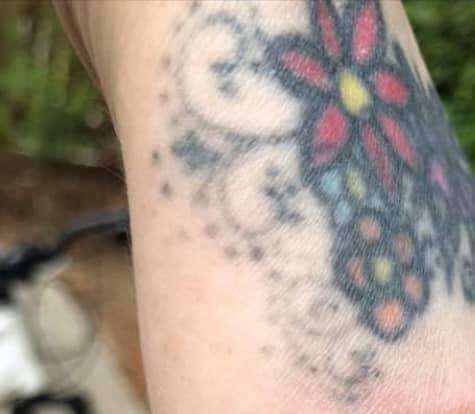 I'm removing my tattoo. does it hurt? – CINCO