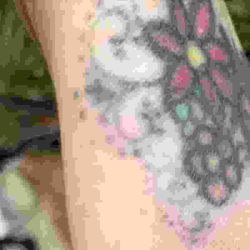 Laser Tattoo Removal Norfolk