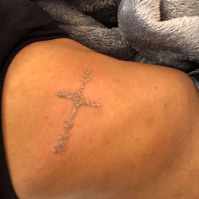 Shoulder Tattoo Removal